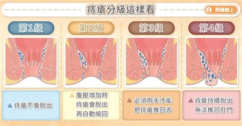 內外痣|痔瘡症狀會自己好嗎？內痣、外痣症狀差異、治療看什。